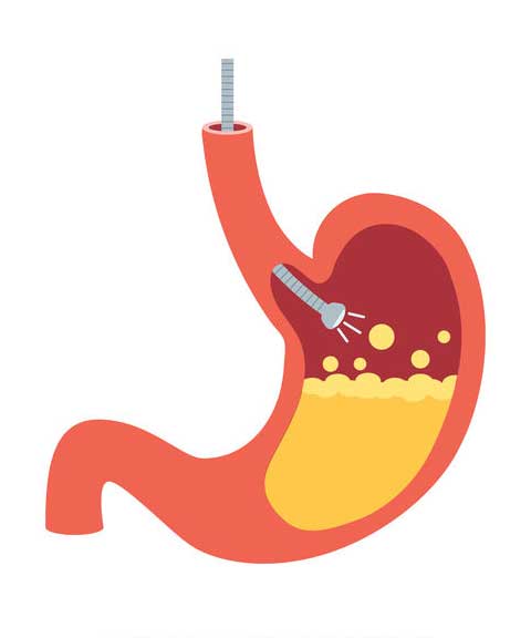 Endoscopie